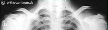 Röntgenaufnahme Schultereckgelenkssprengung