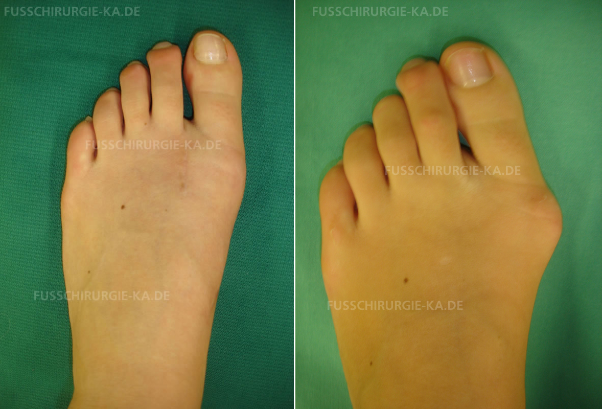 Operative Korrektur Hallux valgus Operative Korrektur Hallux valgus