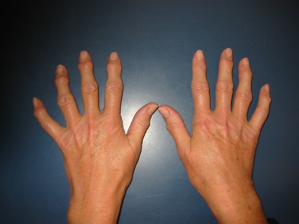 heberden-arthrose-finger