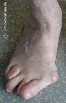 Hallux valgus mit Hammer- und Krallenzehen