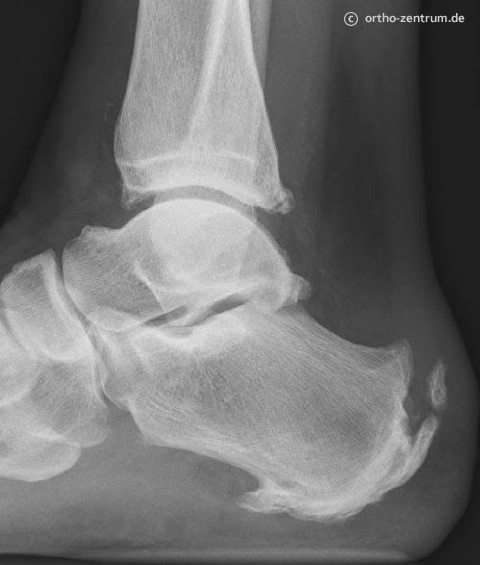 Röntgenbild Verkalkungen am Achillessehnenansatz