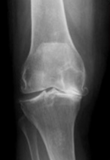 Röntgenbild Arthrose des Kniegelenks (Gonarthrose)