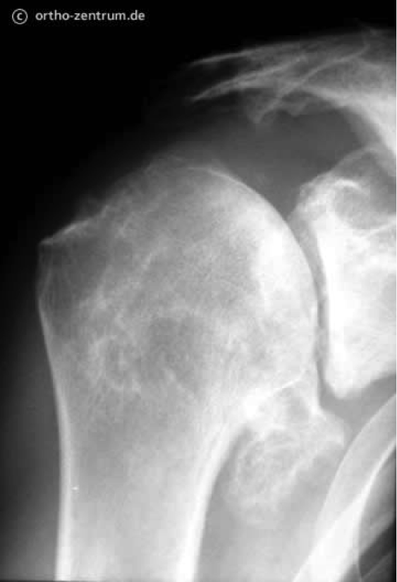 Röntgenbild ausgeprägte Arthrose des Schultergelenkes