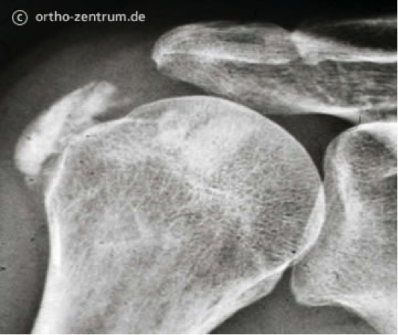 Röntgenbild Kalkeinlagerung (Tendinosis calcarea)