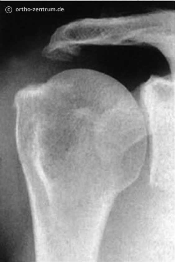 Röntgenbild Knöcherne Einengung des Subacromialraumes