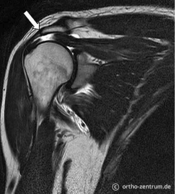Supraspinatussehne teilruptur der Partialläsion der