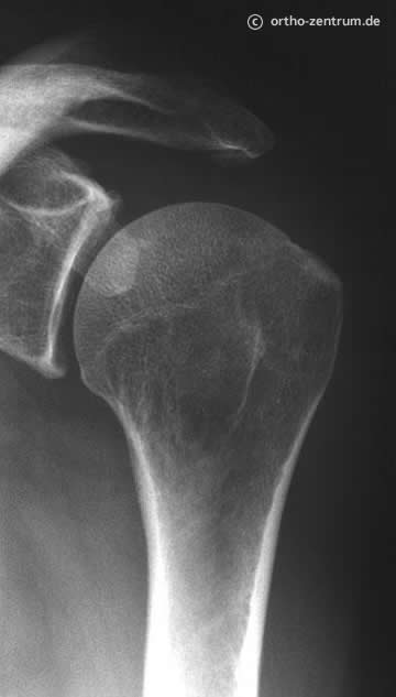 Röntgenbild eines Schultergelenkes
