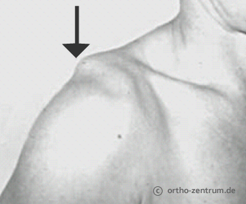 Schultereckgelenkssprengung mit Schlüsselbeinhochstand