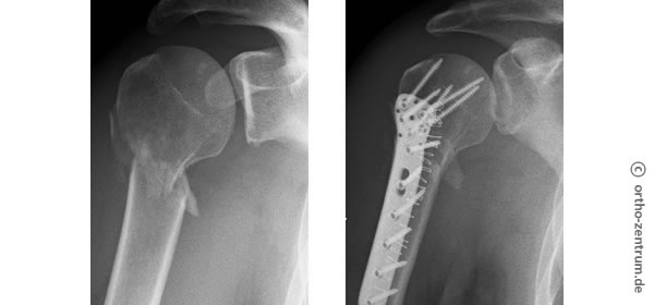 Röntgenbild Bruch des Oberarms mit Fixierung