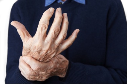 Rheumatoide Arthritis Handgelenk