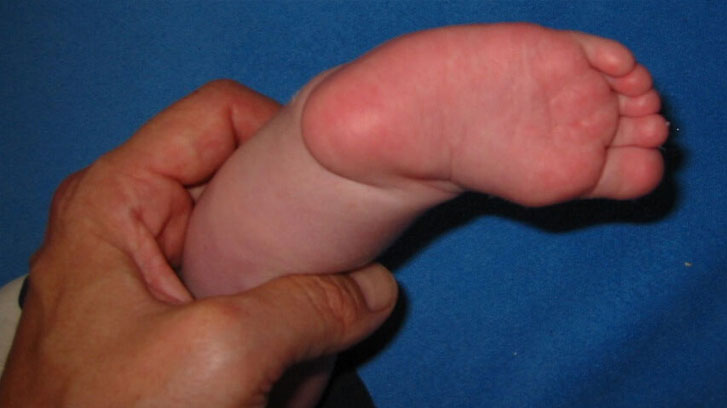 Ausgeprägter Klumpfuß beidseits bei einem Neugeborenem