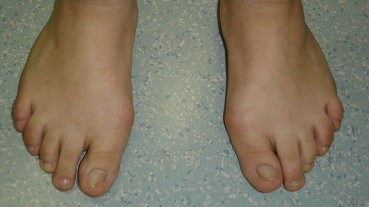 Hallux valgus sowie Krallenzehen an beiden Füßen