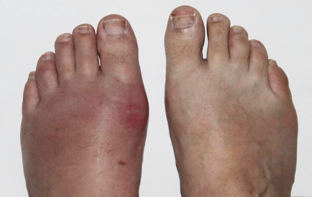 Arthritis mit Schwellung und Rötung am linken Fuß