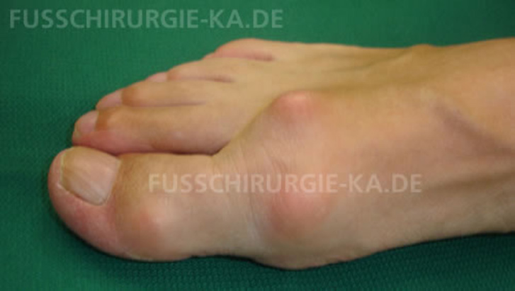 Arthrose Hallux rigidus