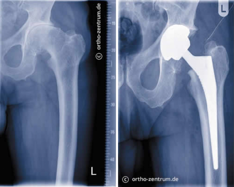 Röntgenbild Hüftendoprothese