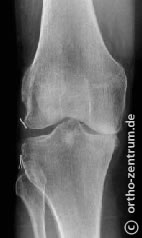 Röntgenbild einer Gonarthrose