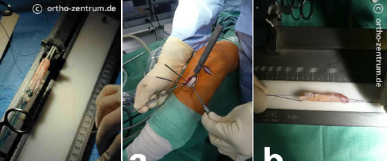 Semitendinosus und Patellasehnentransplantat