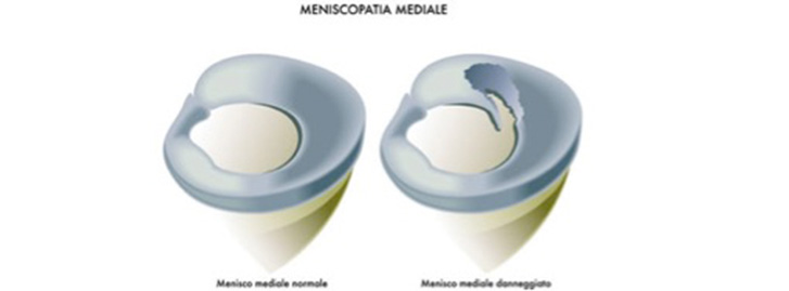 Meniscopatia mediale