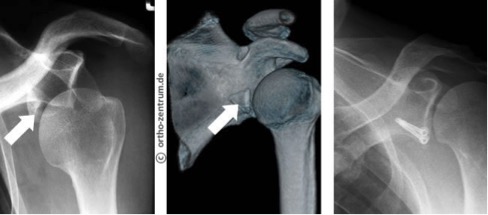Schultergelenksverrenkung Luxation