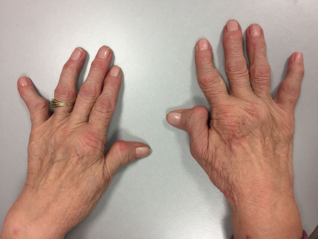 Rheumatoide Arthritis Hand